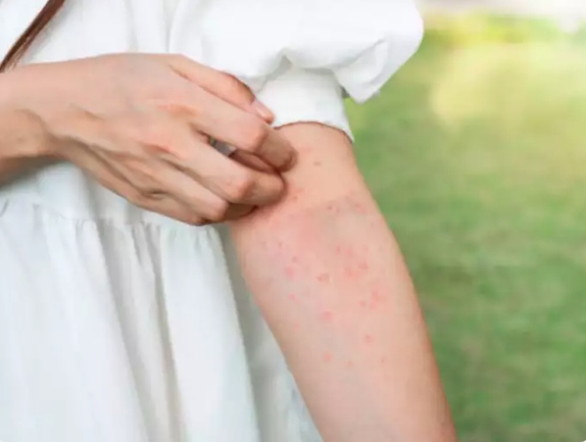 Dị ứng thực phẩm