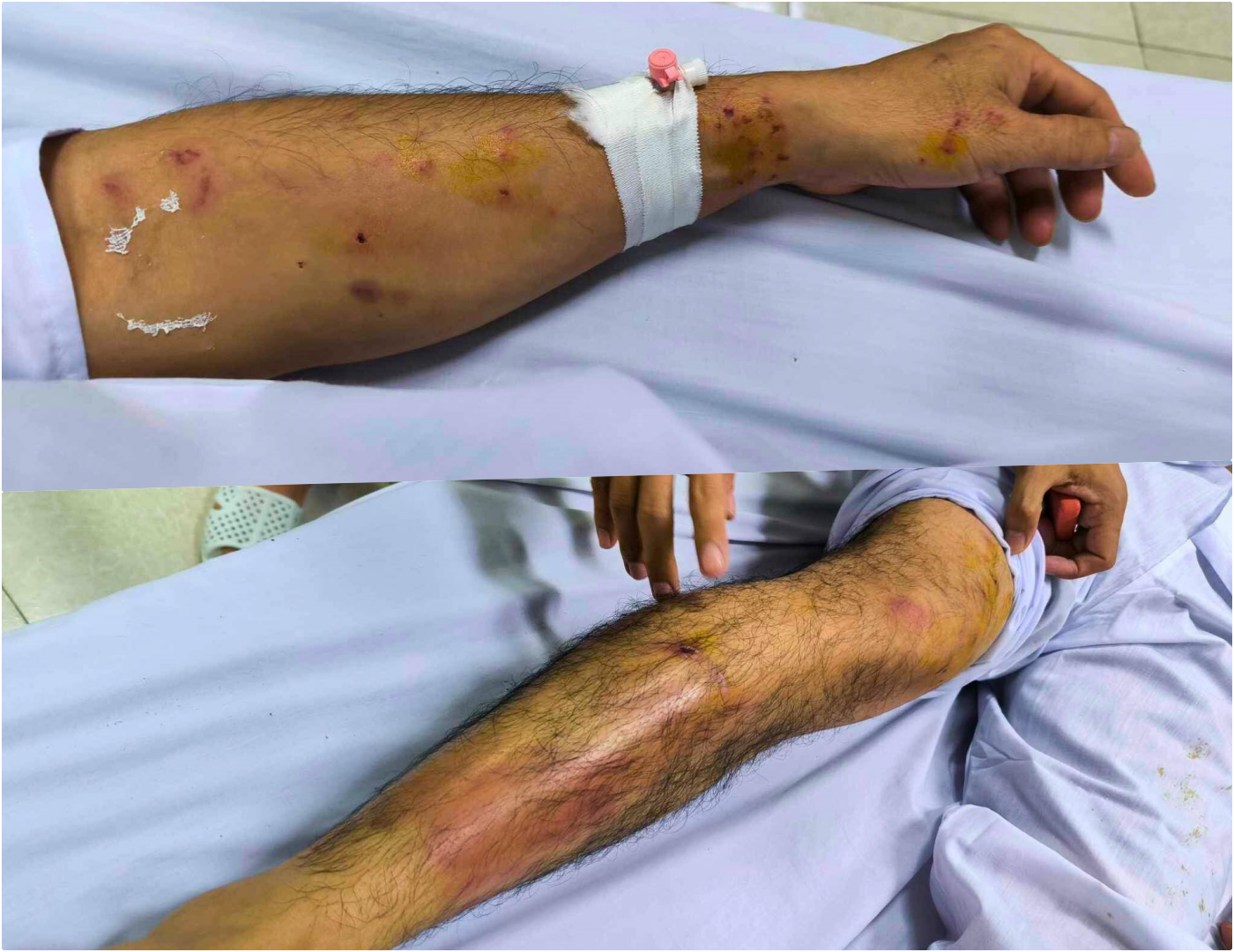 Vết thương trên cánh tay phi công